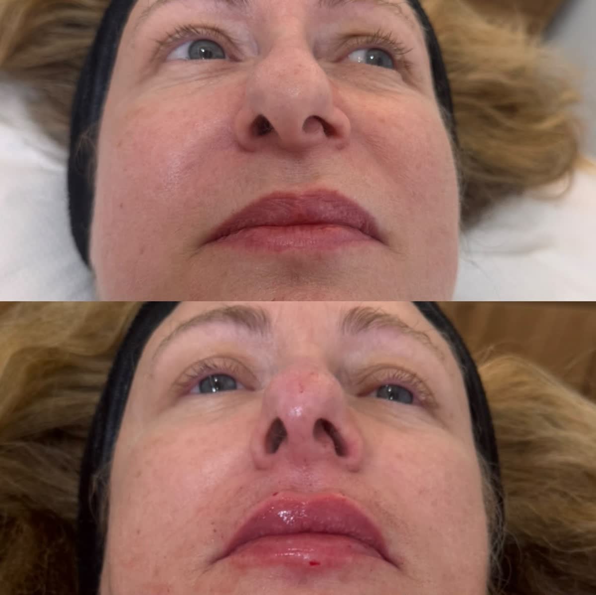 Antes y después de labios con ácido hialurónico en Cleo Clinic, Elche (paciente Encarna)