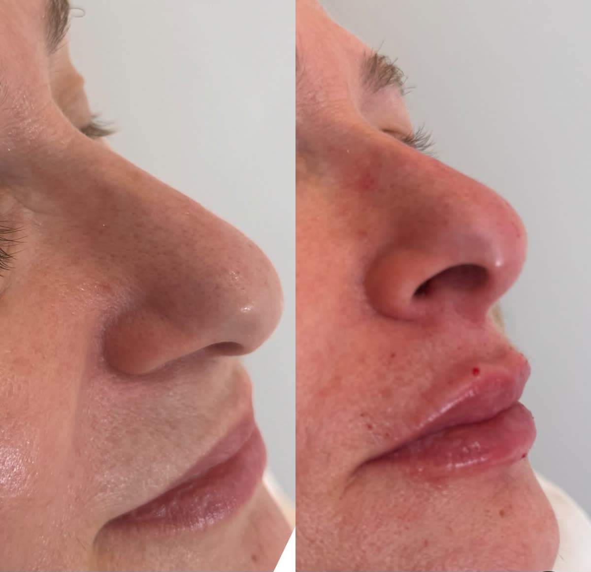 Antes y después de rinomodelación sin cirugía en Cleo Clinic, Elche (paciente Encarna, perfil)